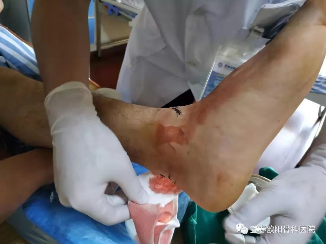 少年腳跟被玻璃割裂，手足外科醫(yī)師緊急手術(shù)