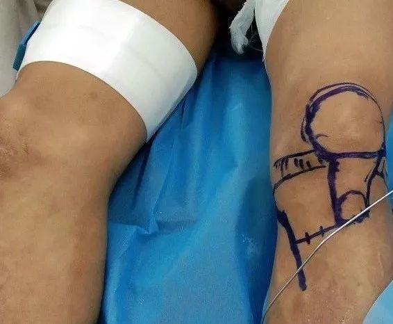 我院保膝治療又獲成功，關(guān)節(jié)病患者的福音！