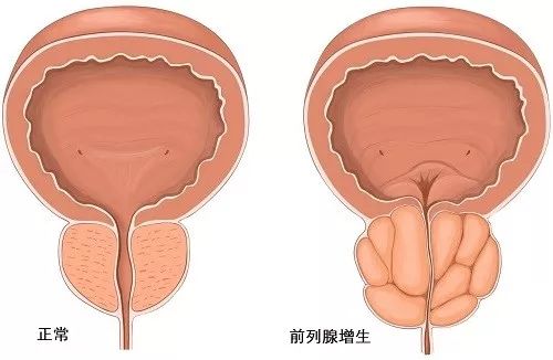 前列腺增生，尿頻、尿急怎么辦？等離子電切術(shù)治愈！